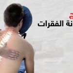 علاج خشونة الفقرات