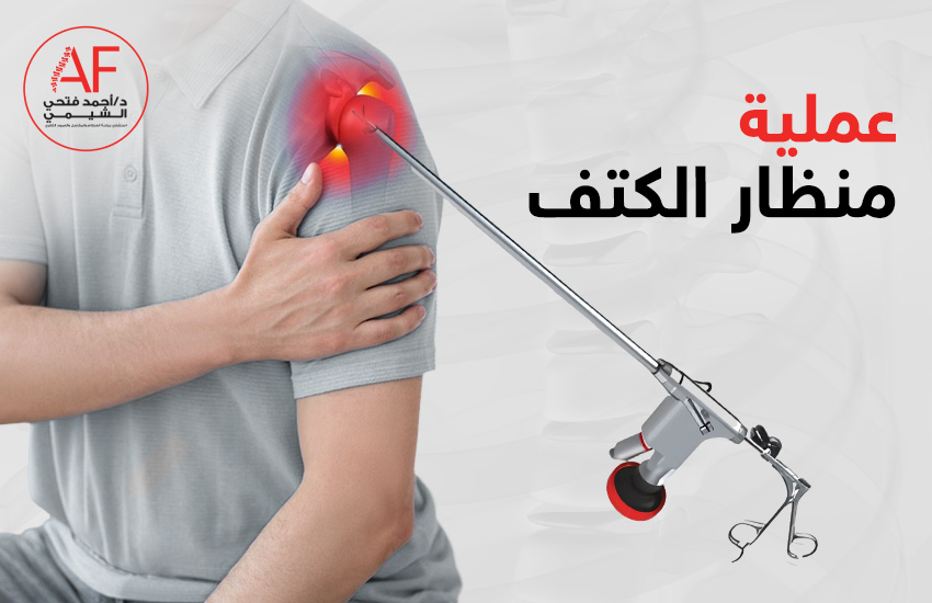 عملية منظار الكتف