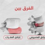 الفرق بين الانزلاق الغضروفي وانزلاق الفقرات