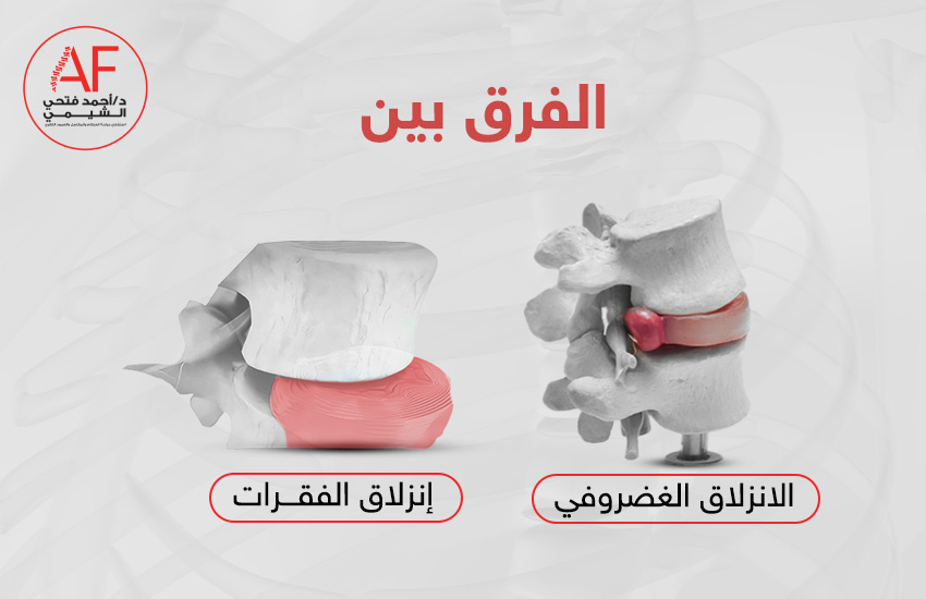 الفرق بين الانزلاق الغضروفي وانزلاق الفقرات