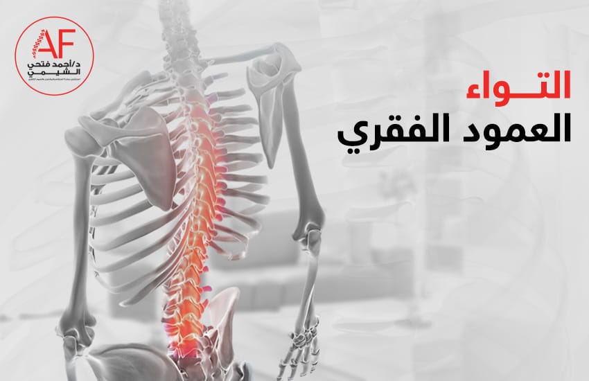 التواء العمود الفقري