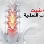 عملية تثبيت الفقرات القطنية
