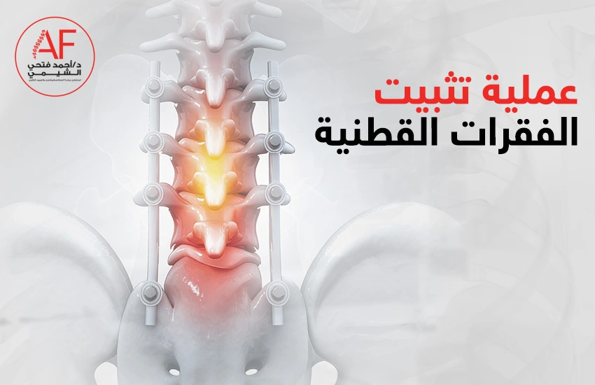 عملية-تثبيت-الفقرات-القطنية عملية تثبيت الفقرات القطنية